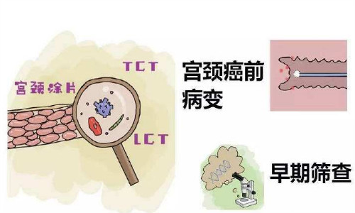 什么是宫颈癌前病变？