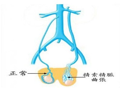 男性精索静脉曲张手术的费用是多少？