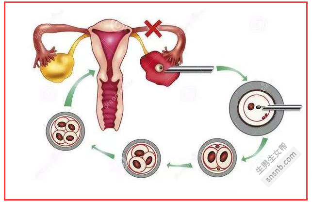 输卵管粘连的症状有哪些？输卵管粘连的四个主要原因