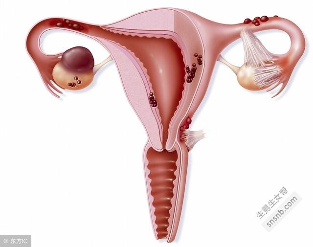 子宫肌瘤主要表现在这4个方面，你要预防