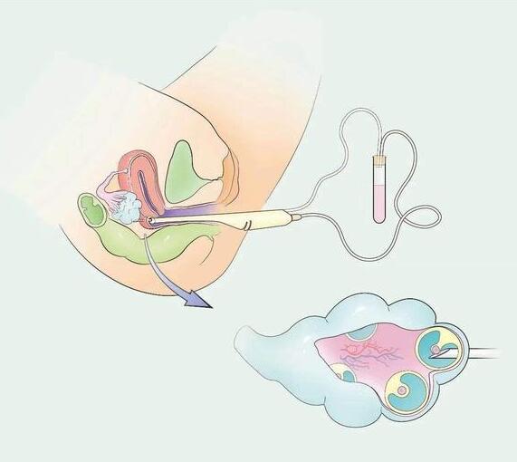 提高卵子质量的方法,在试管婴儿中不要害怕卵子质量差。